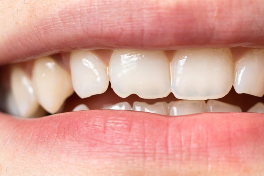 Macro close-up of human teeth. Shows the chipped tooth. The effect of the cutter's tooth from biting the seeds shell and solid food. For dentists, dental clinics - aesthetic minor damage